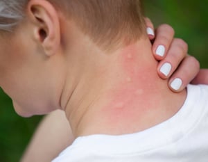 bitten-by-mosquito-resized